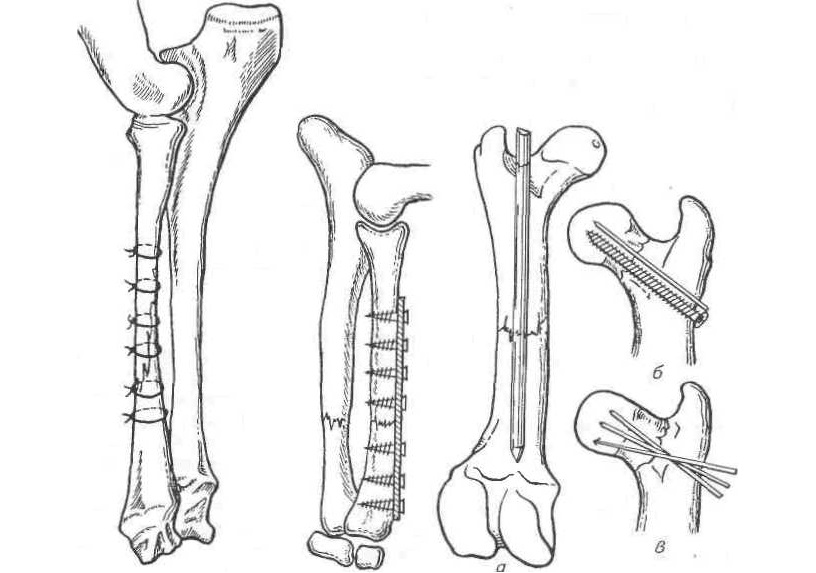 остеосинтез
